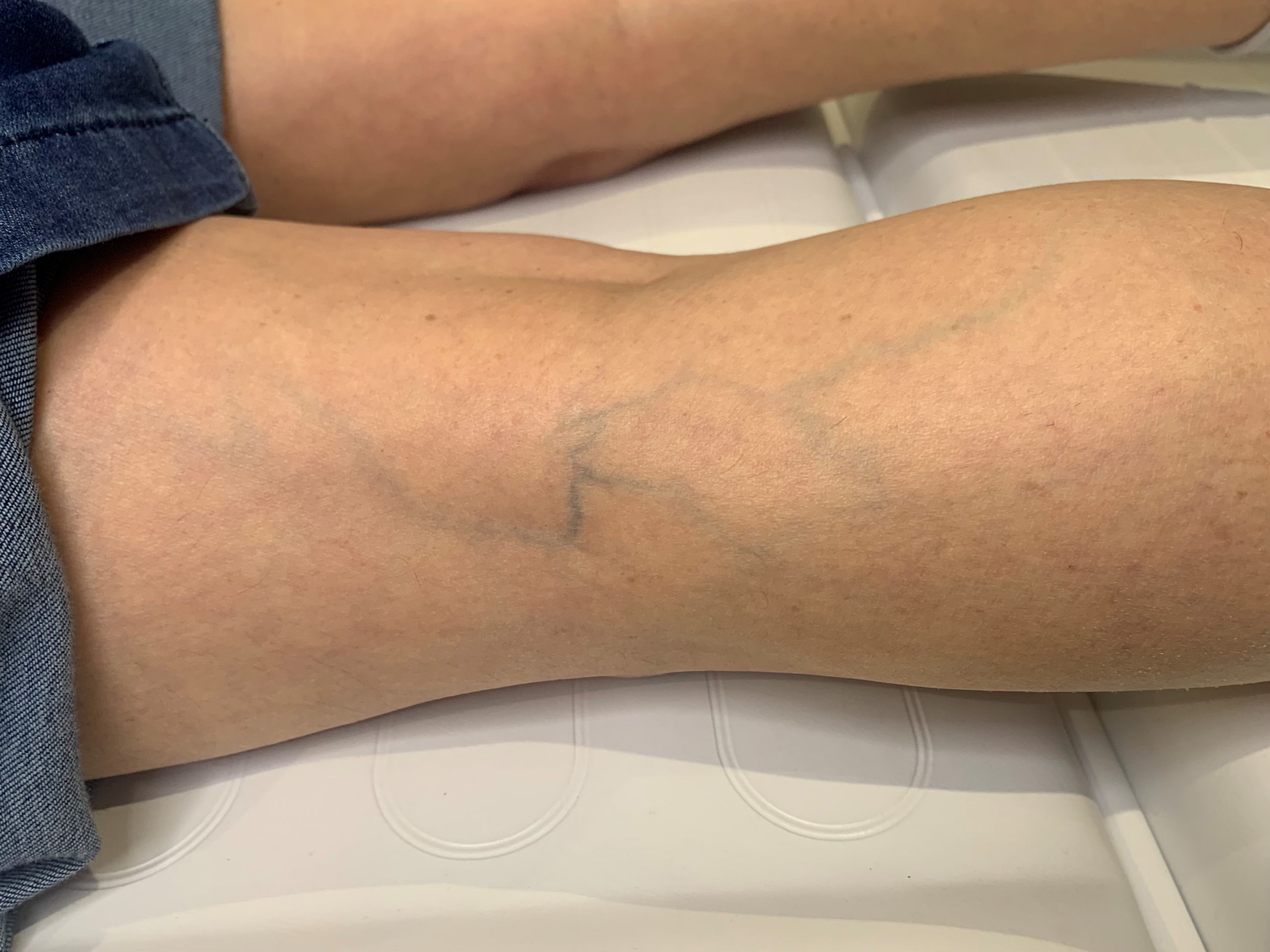 Leg Veins Appearance And Treatment Lowen Dental Spa